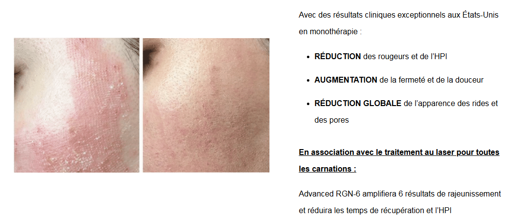 Advanced RGN-6